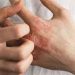 Kenali Jenis-Jenis dan Gejala Dermatitis