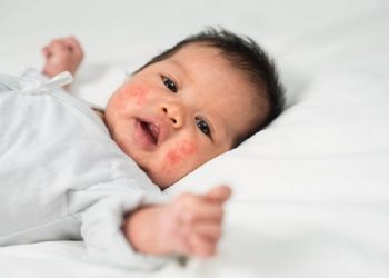 Berikut Cara Mengatasi Eksim Pada Bayi