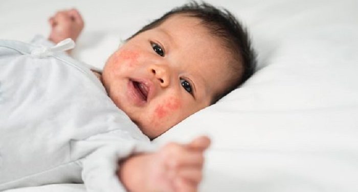 Berikut Cara Mengatasi Eksim Pada Bayi