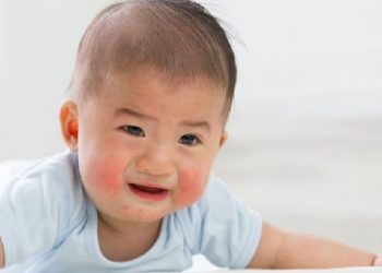 Para Orang Tua Wajib Perhatikan Perawatan Wajah Anak yang Mengalami Eksim