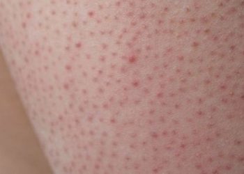 Ketahui Apa Itu Penyakit Keratosis Pilaris pada Kulit Wajah