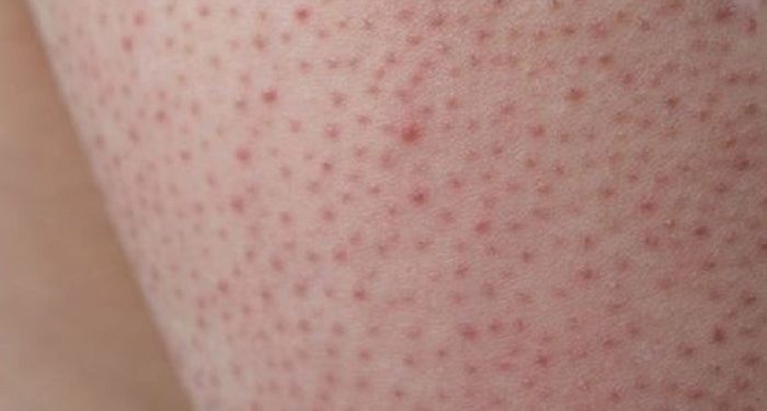 Ketahui Apa Itu Penyakit Keratosis Pilaris pada Kulit Wajah