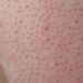 Ketahui Apa Itu Penyakit Keratosis Pilaris pada Kulit Wajah