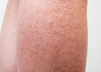 Beberapa Cara untuk Menurunkan Risiko Terkena Keratosis Pilaris