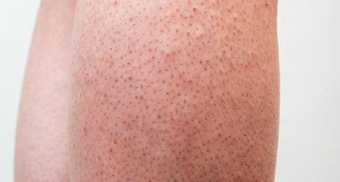 Beberapa Cara untuk Menurunkan Risiko Terkena Keratosis Pilaris