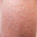 Beberapa Cara untuk Menurunkan Risiko Terkena Keratosis Pilaris