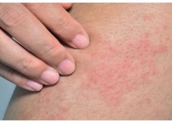 Beberapa Tips Mencegah Biang Keringat