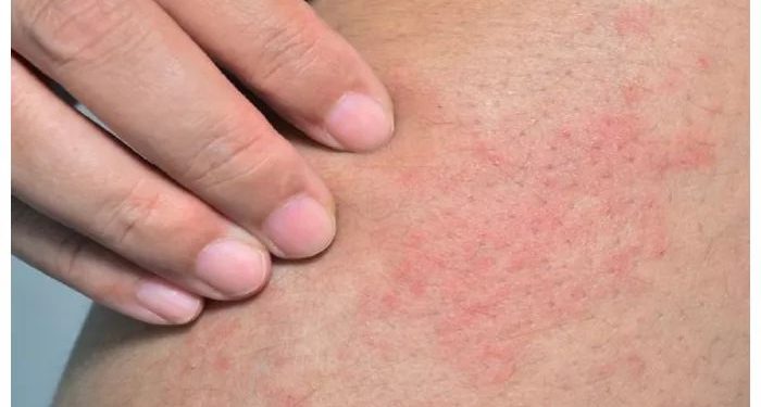 Beberapa Tips Mencegah Biang Keringat