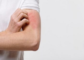 Kenali Ruam Karena Kecemasan dan Gejalanya