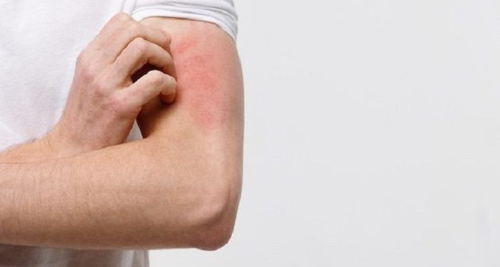 Kenali Ruam Karena Kecemasan dan Gejalanya