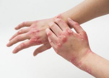 Beberapa Penyebab Ruam Karena Kecemasan