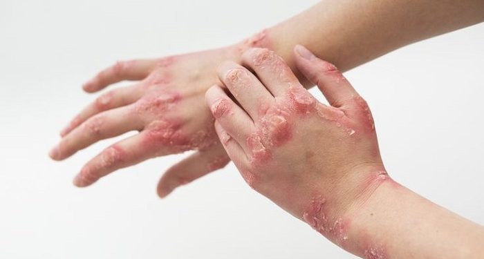 Beberapa Penyebab Ruam Karena Kecemasan