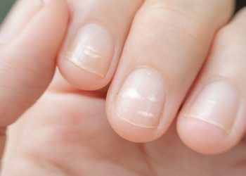 Penyebab Munculnya Bintik Putih di Kuku