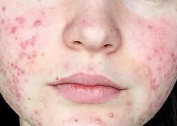 Tips Atasi Kulit Breakout karena Kesalahan Penggunaan Produk