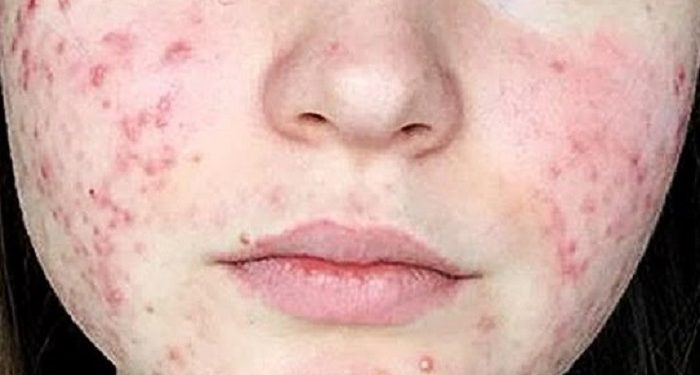 Tips Atasi Kulit Breakout karena Kesalahan Penggunaan Produk