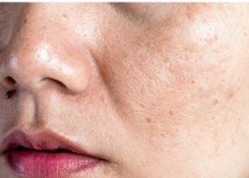 Jenis-Jenis Flek Hitam yang Perlu Kamu Ketahui