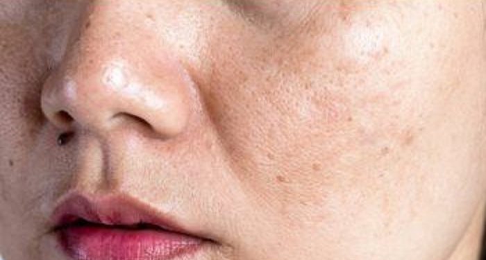 Jenis-Jenis Flek Hitam yang Perlu Kamu Ketahui