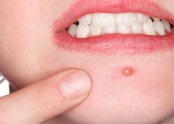 Simak Beberapa Kebiasaan yang Dapat Memperparah Jerawat