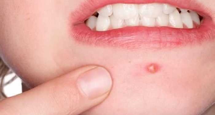 Simak Beberapa Kebiasaan yang Dapat Memperparah Jerawat