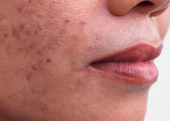 Kenali Apa Itu Jerawat Papula dan Cara Mengobatinya