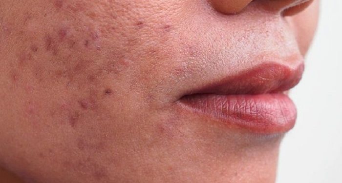 Kenali Apa Itu Jerawat Papula dan Cara Mengobatinya