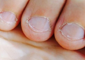 Beberapa Kelainan pada Kuku yang Berpotensi Peradangan Kronis