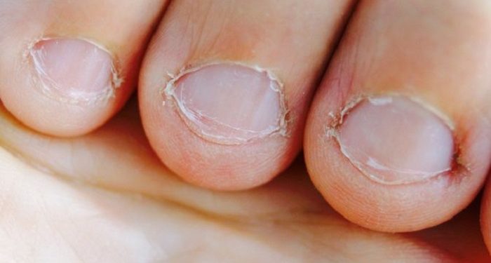 Beberapa Kelainan pada Kuku yang Berpotensi Peradangan Kronis