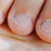 Beberapa Kelainan pada Kuku yang Berpotensi Peradangan Kronis