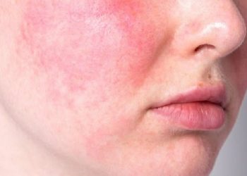 Perbedaan Kulit Sensitif dan Alergi