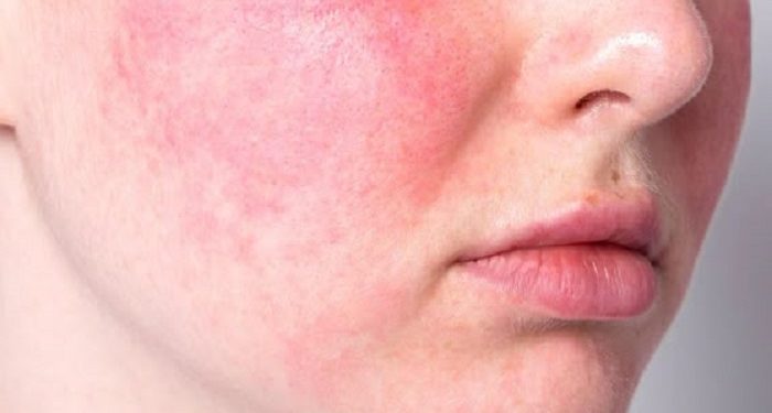 Perbedaan Kulit Sensitif dan Alergi