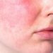 Perbedaan Kulit Sensitif dan Alergi