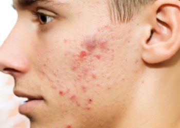 Empat Penyebab Kulit Menjadi Sensitif