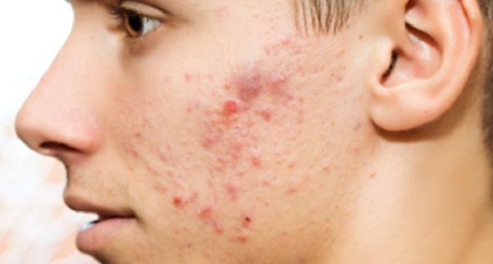 Empat Penyebab Kulit Menjadi Sensitif