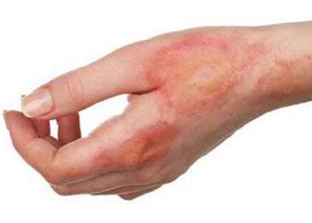 Perbedaan Kusta Basah dan Kusta Kering