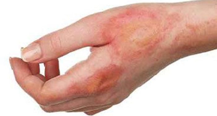 Perbedaan Kusta Basah dan Kusta Kering