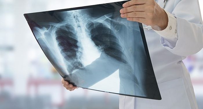 Berikut Tanda Paru-Paru Kamu Tidak Sehat