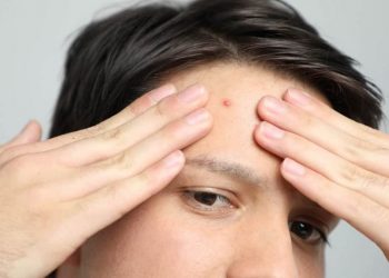 Beberapa Perawatan Bekas Jerawat yang Ampuh Sesuai Jenisnya