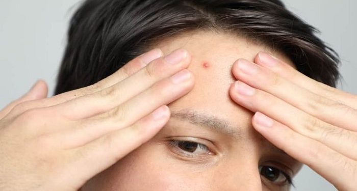 Beberapa Perawatan Bekas Jerawat yang Ampuh Sesuai Jenisnya