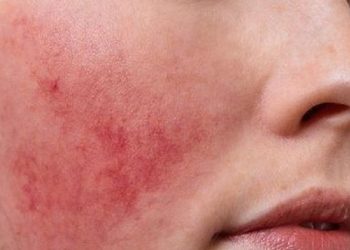 Cara Mengatasi Penyakit Rosacea pada Kulit