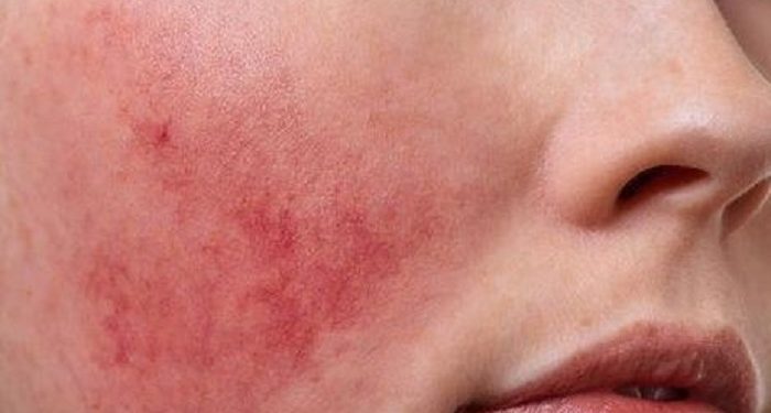 Cara Mengatasi Penyakit Rosacea pada Kulit