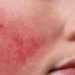 Cara Mengatasi Penyakit Rosacea pada Kulit