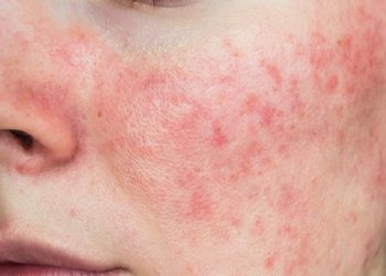 Kenali Apa Itu Rosacea dan Penyebabnya