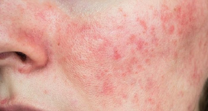 Kenali Apa Itu Rosacea dan Penyebabnya