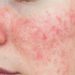 Kenali Apa Itu Rosacea dan Penyebabnya