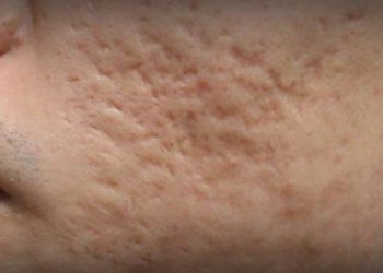 Apakah Bopeng Bekas Jerawat Bisa Hilang? Simak Penjelasannya Berikut