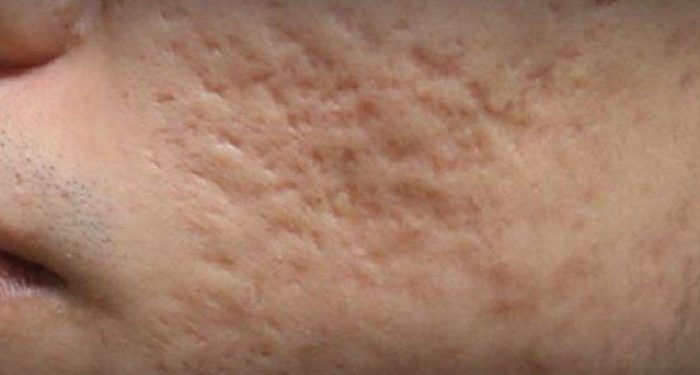 Apakah Bopeng Bekas Jerawat Bisa Hilang? Simak Penjelasannya Berikut