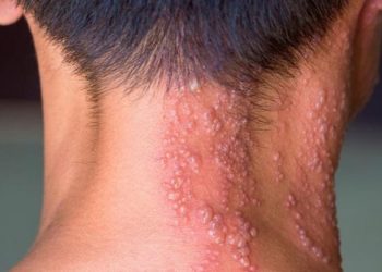 Vaksin Herpes Zoster Berpotensi Turunkan Risiko Serangan Jantung dan Stroke