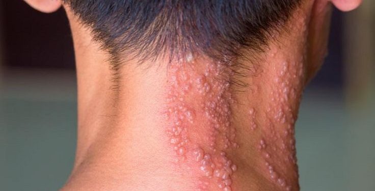 Vaksin Herpes Zoster Berpotensi Turunkan Risiko Serangan Jantung dan Stroke
