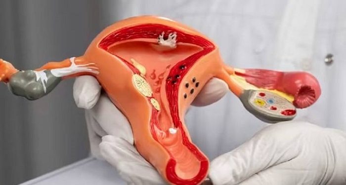 Simak Lima Kelompok yang Paling Berisiko Terkena kanker Serviks