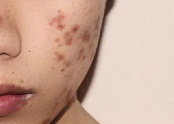 Ketahui Masalah Kulit di Setiap Fase Usia dan Cara Mengatasinya